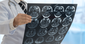 Challenges of Securing Accident Benefits for a Traumatic Brain Injury