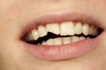 woman with chipped tooth